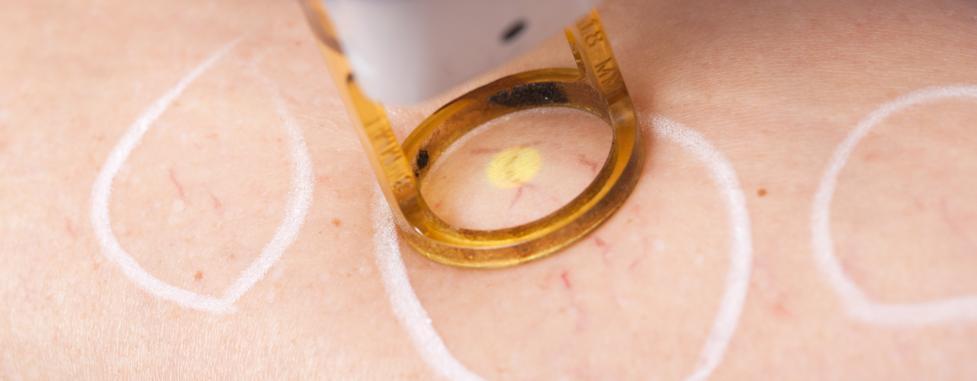 tratamiento aranas vasculares