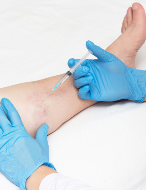 servicios de trombosis venosa