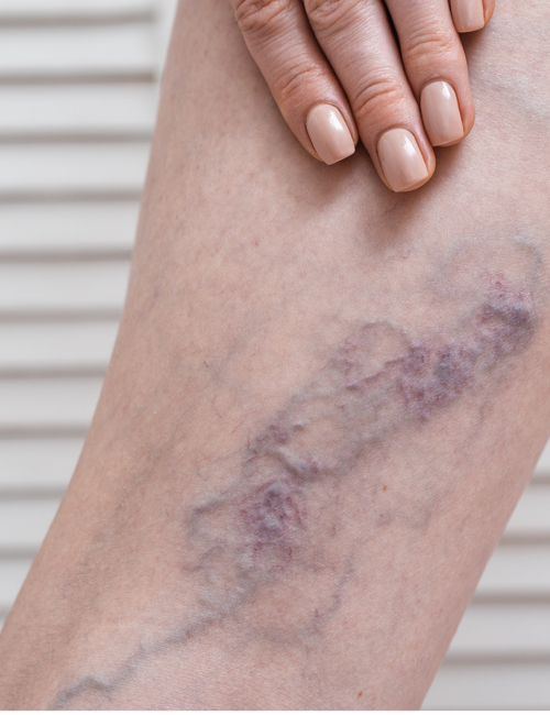 deteccion seguimiento de trombosis